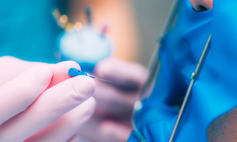 Beneficios de la Endodoncia