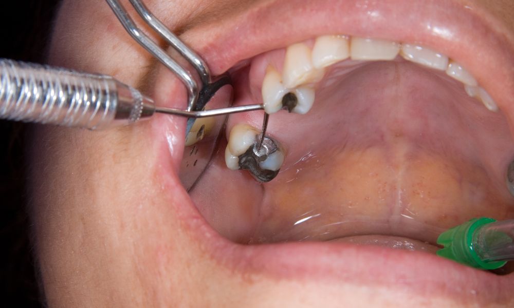 Beneficios de los Tratamientos de Rehabilitación Oral