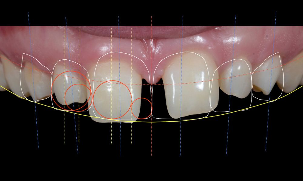 Benefits of Smile Design