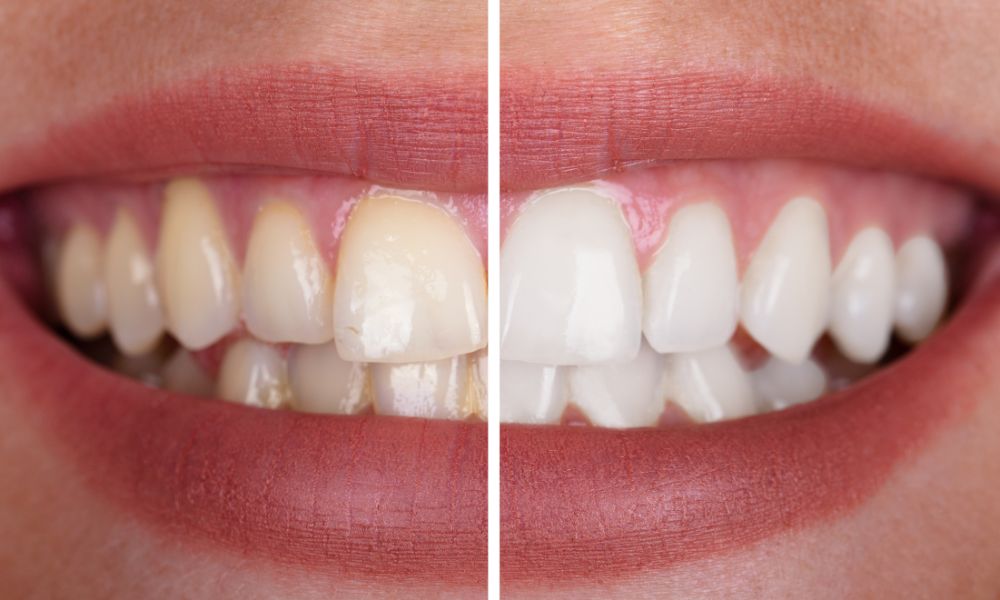 Blanqueamiento Dental