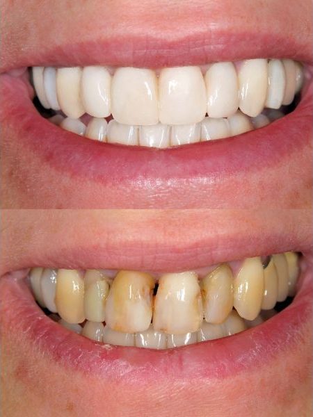 Smile Design