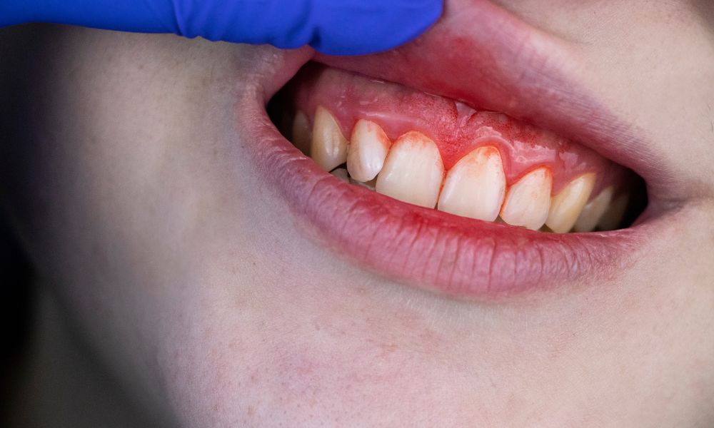 Common Periodontal Diseases