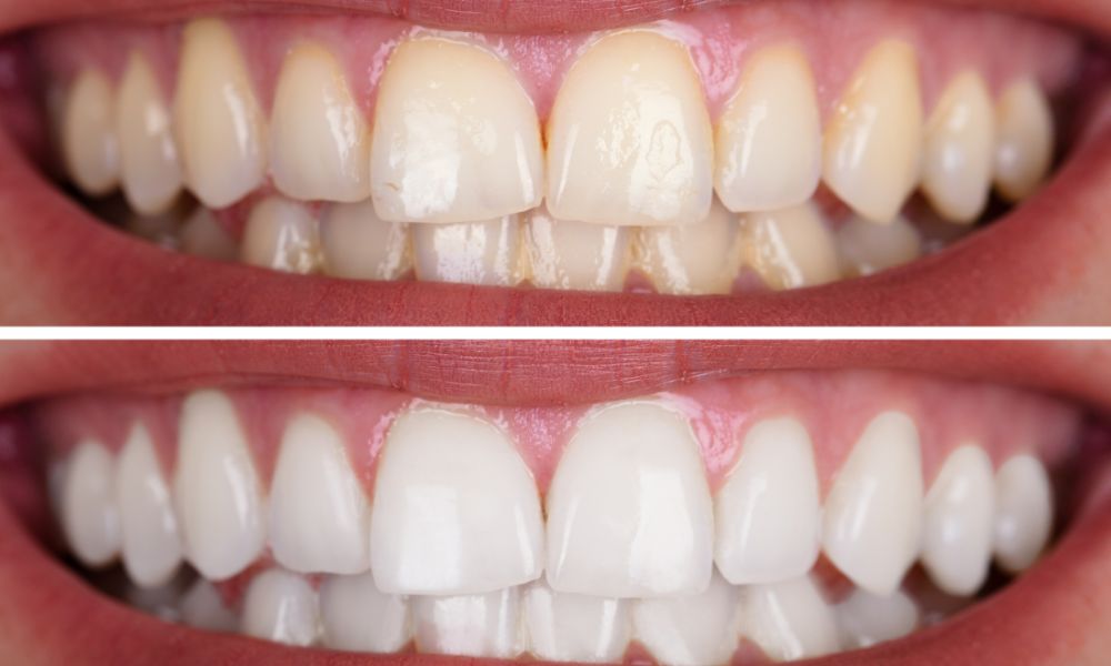 Opciones de Blanqueamiento Dental en Clínica Dental Obarrio