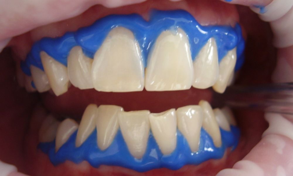 Preguntas Frecuentes sobre Blanqueamiento Dental