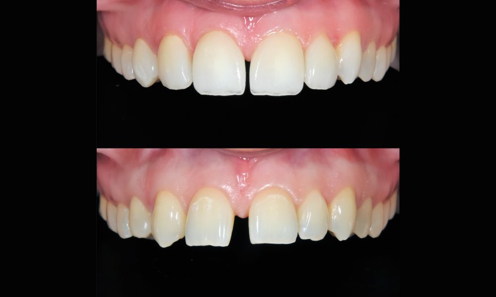 Frequently Asked Questions about Smile Design