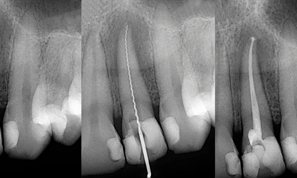 Preguntas Frecuentes sobre Endodoncia