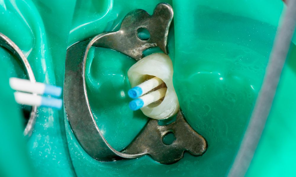 Qué es Endodoncia