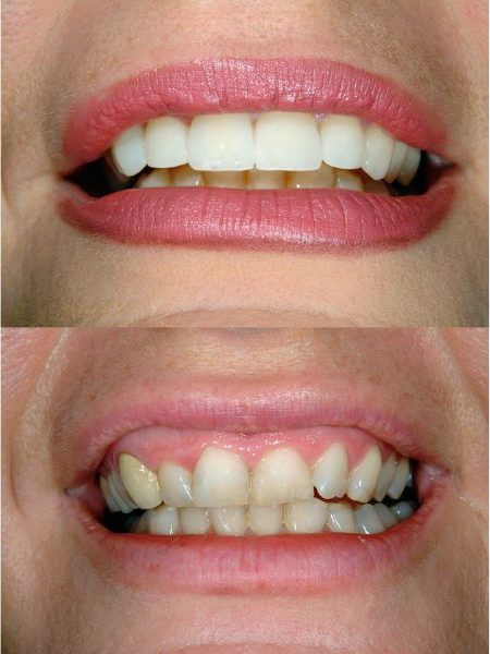 What is Smile Design