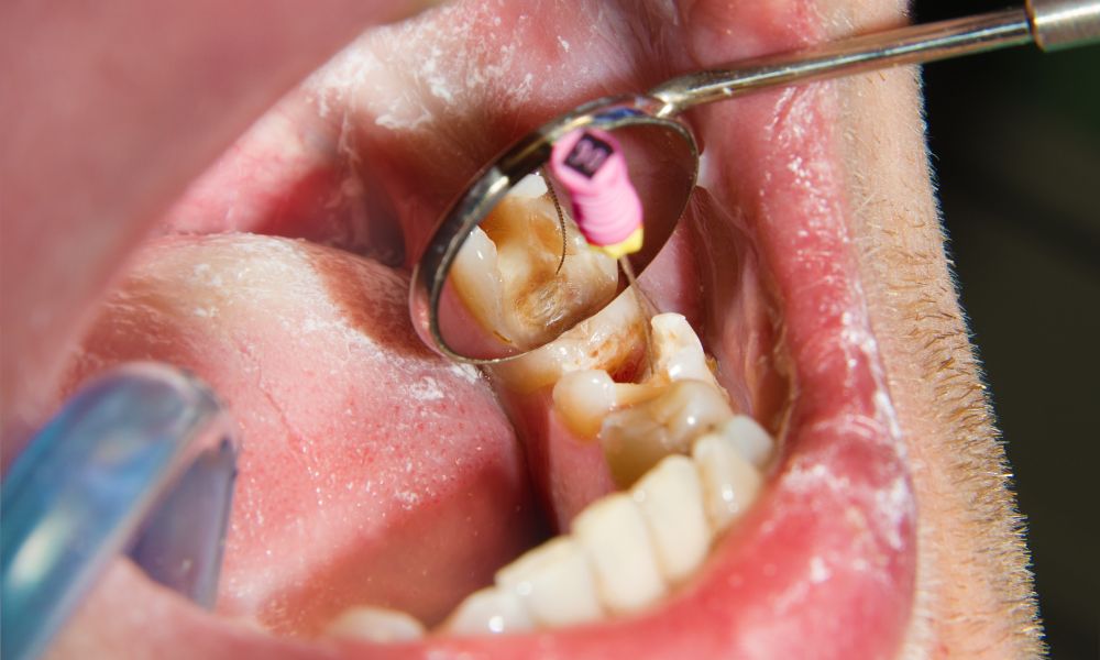 Qué es la Endodoncia