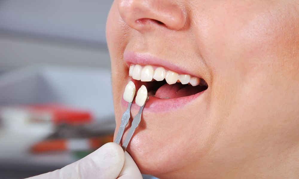 Por qué elegir Clínica Dental Obarrio para tus carillas dentales