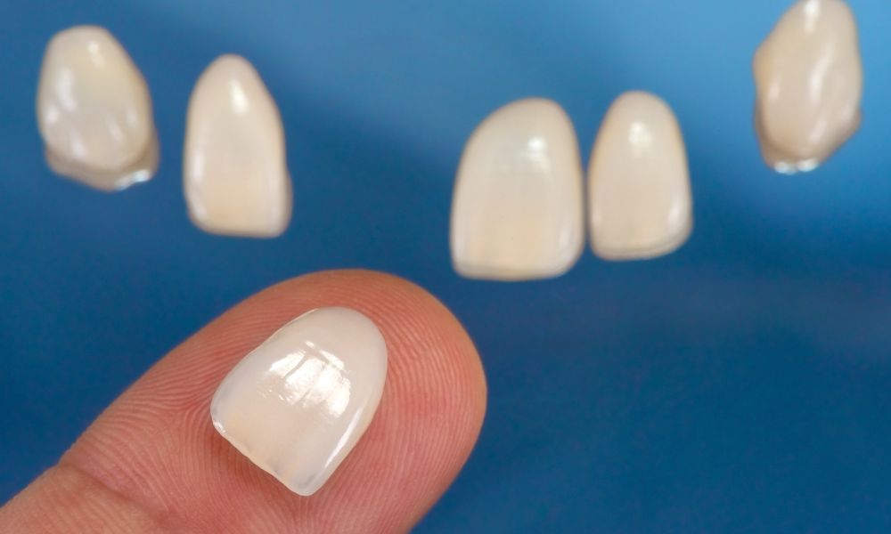 Preguntas frecuentes sobre las carillas dentales