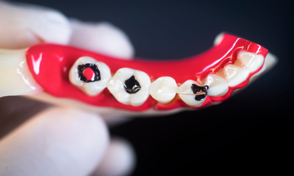 Leading Causes of Tooth Decay