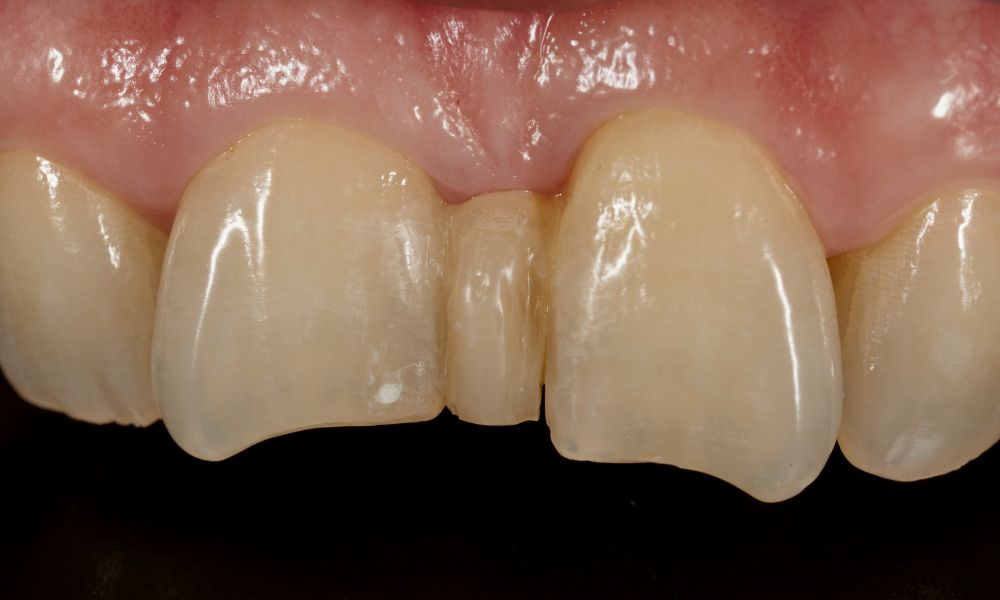 Importance of Treating Tooth Crowding