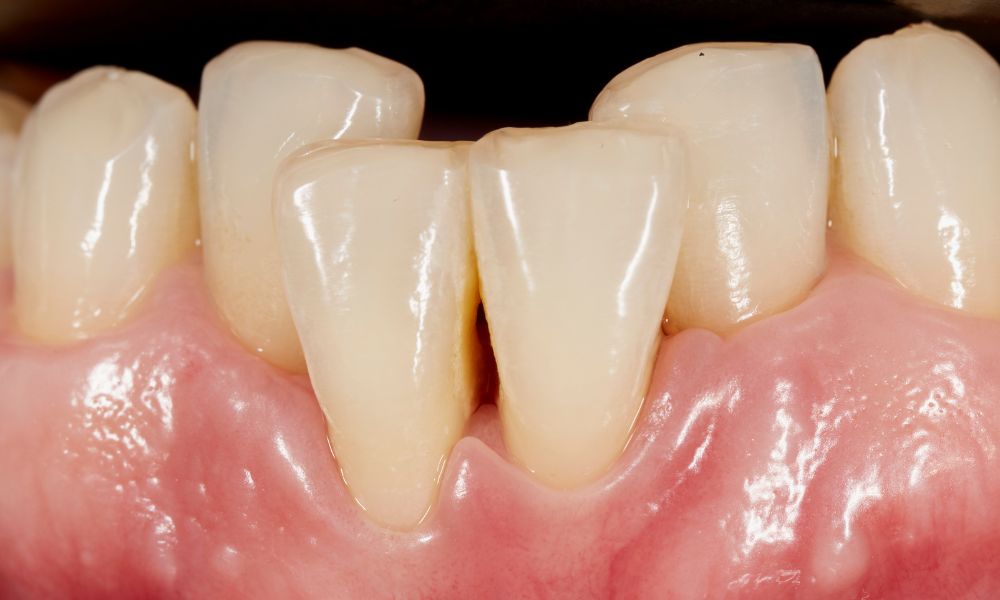 What is Dental Crowding