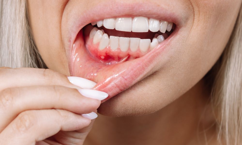 Qué es la Periodontitis