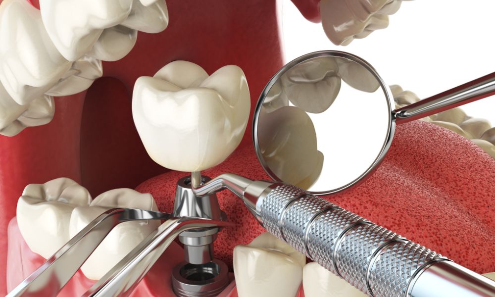 Mantenimiento y Cuidado: Preserva Tu Nueva Sonrisa