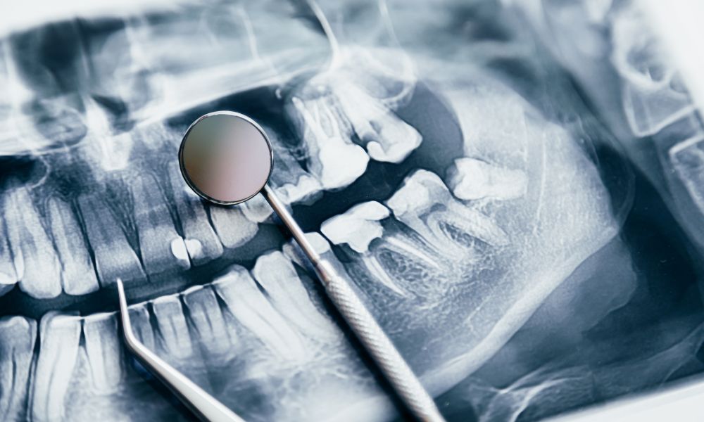 Qué Incluye una Limpieza Dental en Clínica Dental Obarrio