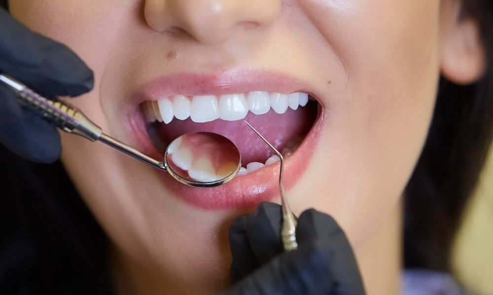 Candidates for Dental Remineralization