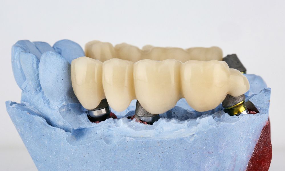 Porcelain Crowns and Bridges in Panama