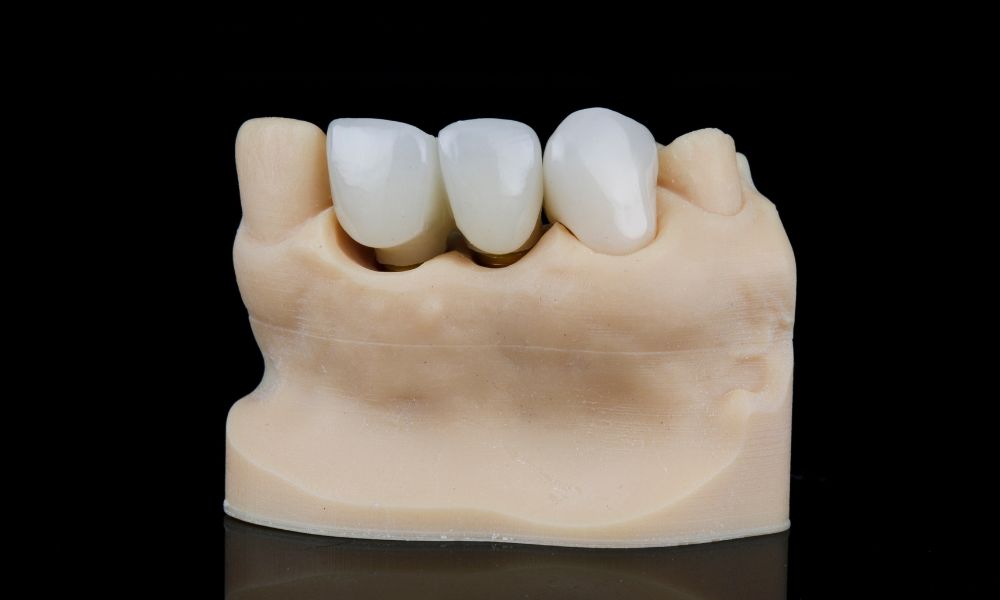Frequently Asked Questions about Porcelain Crowns and Bridges