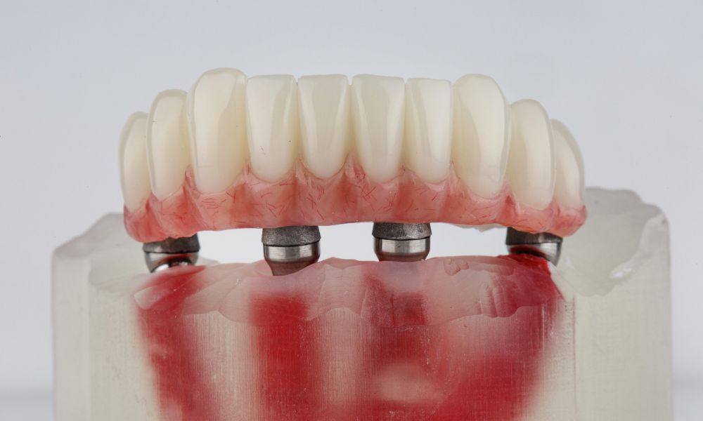 Proceso para Obtener una Prótesis Dental Fija