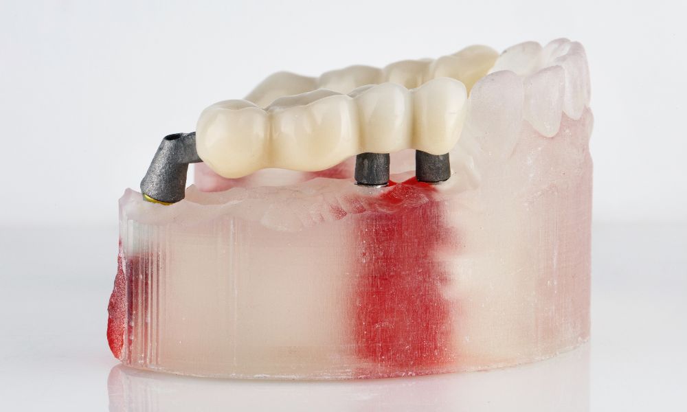 Porcelain Bridges: An Effective Solution for Tooth Loss