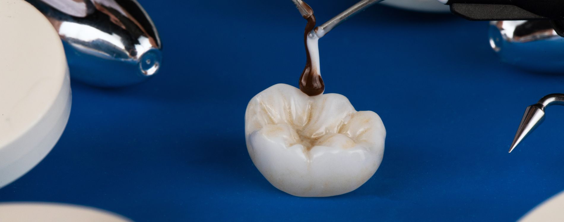 Incrustación Dental Todo lo que Necesitas Saber en Panamá