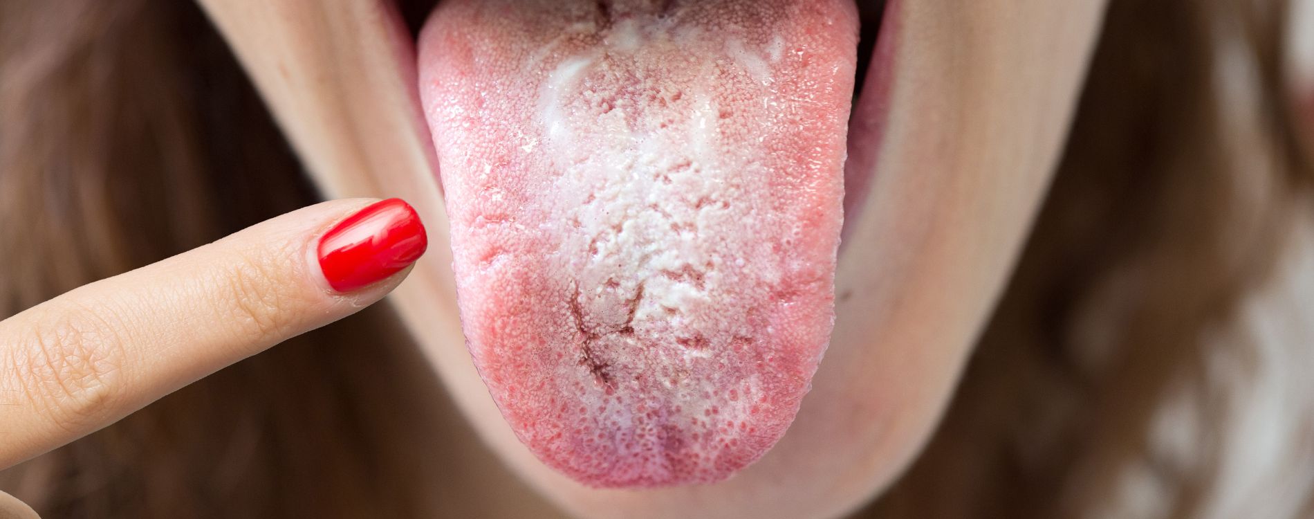 Qué es la Candidiasis Oral