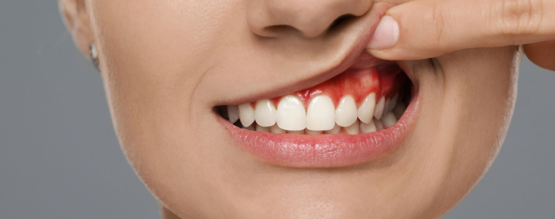 Qué Hacer si se Revienta un Absceso Dental