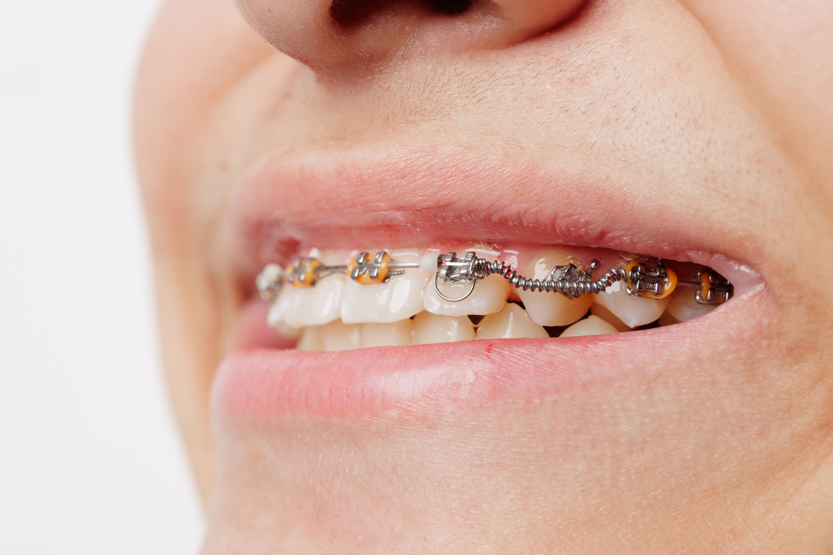 Guía Práctica para Lavar los Dientes con Disyuntor