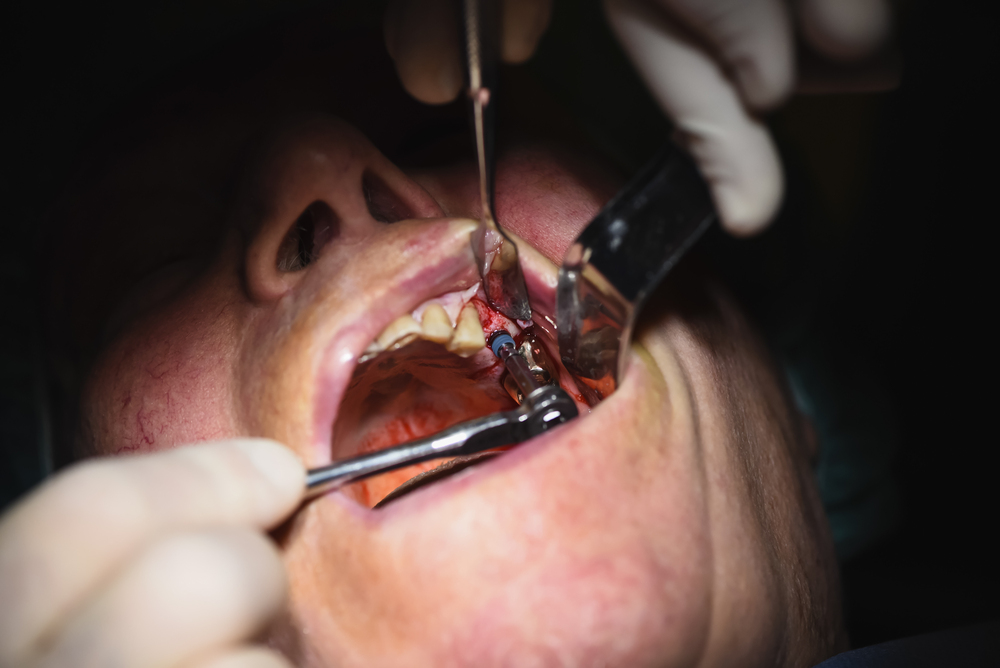 Derribando mitos sobre la cirugía oral en Panamá