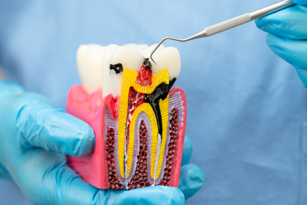 Common Problems of Traditional Endodontic Treatments