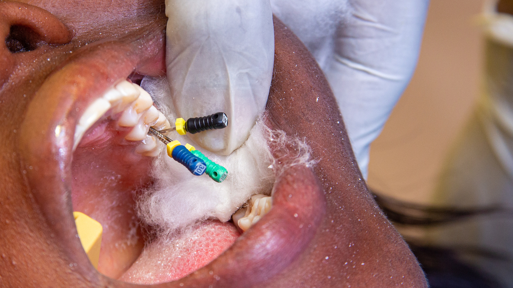 Advantages of microscopic endodontics in Panama