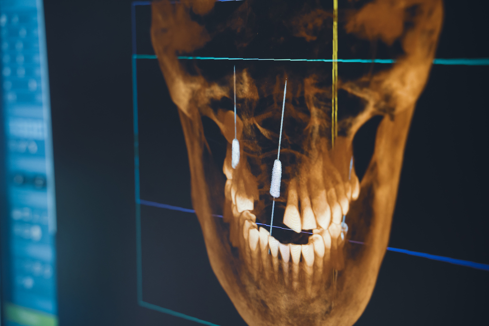 Benefits of Dental CT Scans in Panama