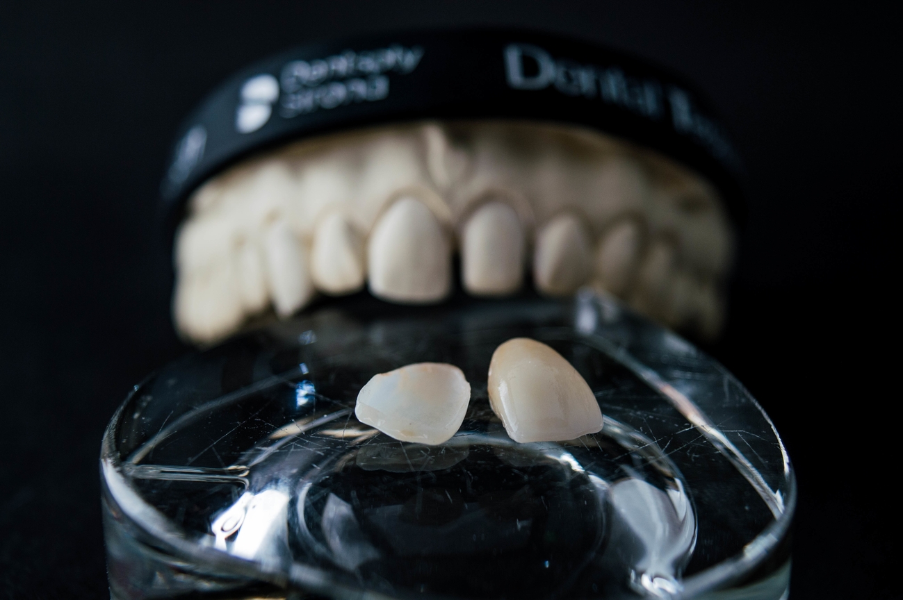 Diastema causas, tipos y opciones de tratamiento ortodóntico