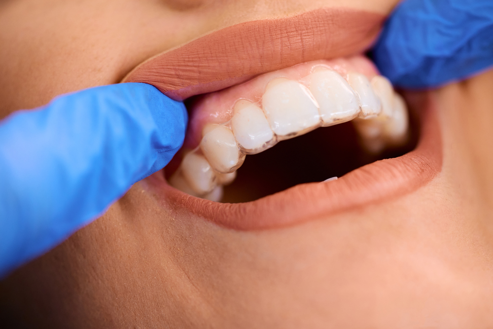 Descubre los Beneficios de Usar una Férula Dental