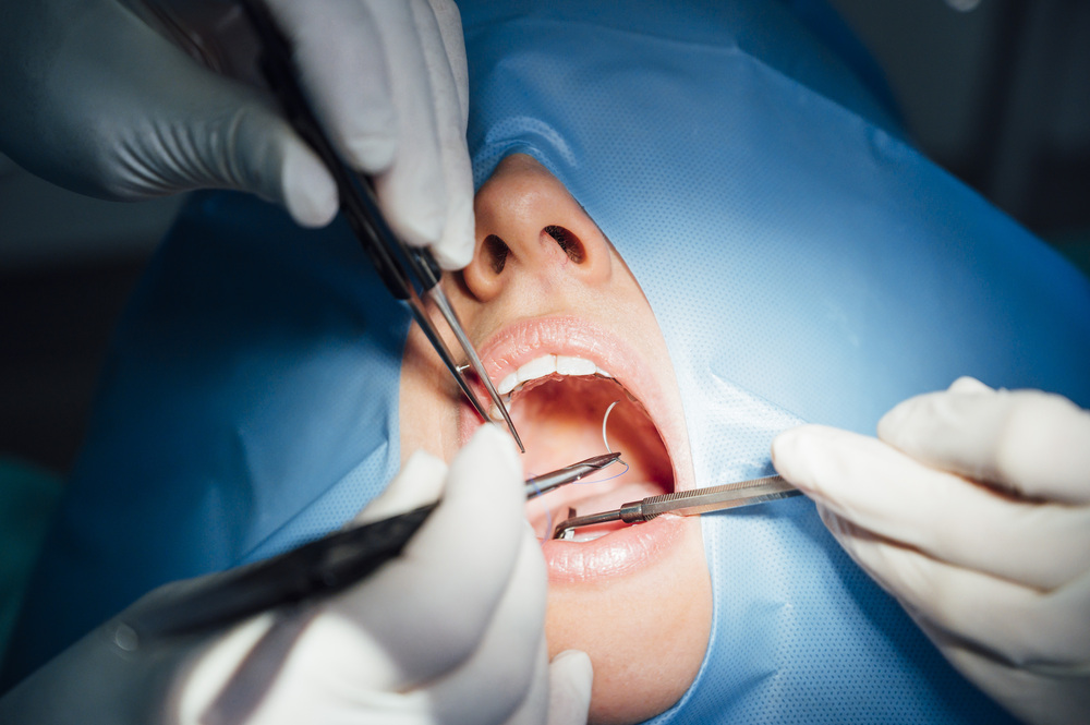 Todo sobre la Cirugía Oral para Quistes Dentales