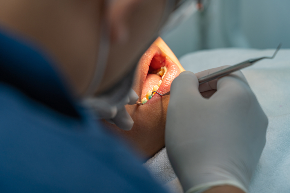 Todo sobre el Tratamiento de Gingivitis en Clínica Dental Obarrio