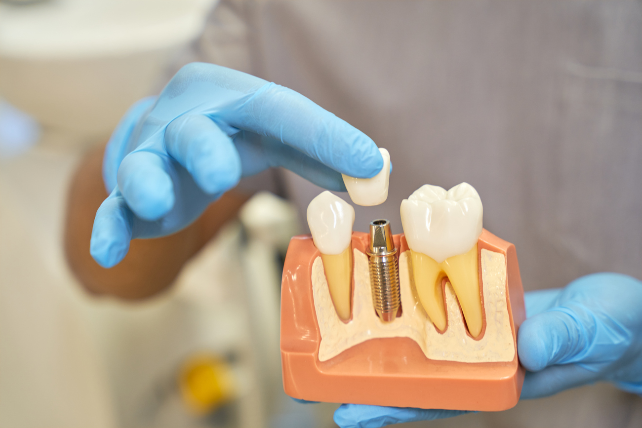 Implantes dentales vs puente fijo cuál elegir según tu caso