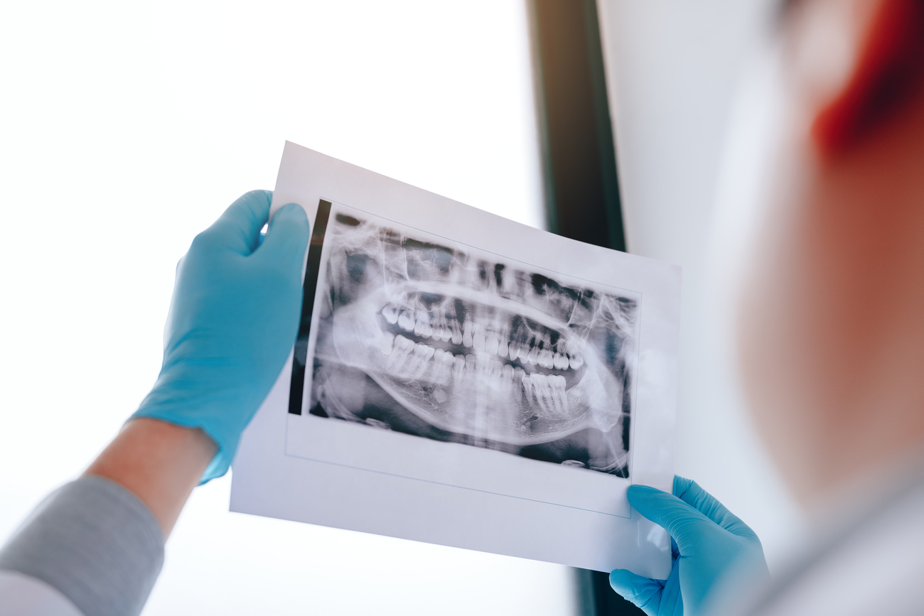 ¿Cuándo una reendodoncia es mejor que extraer el diente